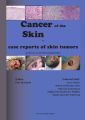 Cancer of the Skin - case reports of skin tumors